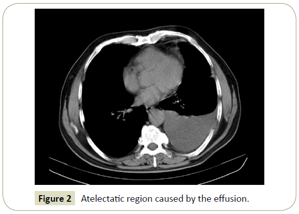 insights-chest-diseases-Atelectatic-region