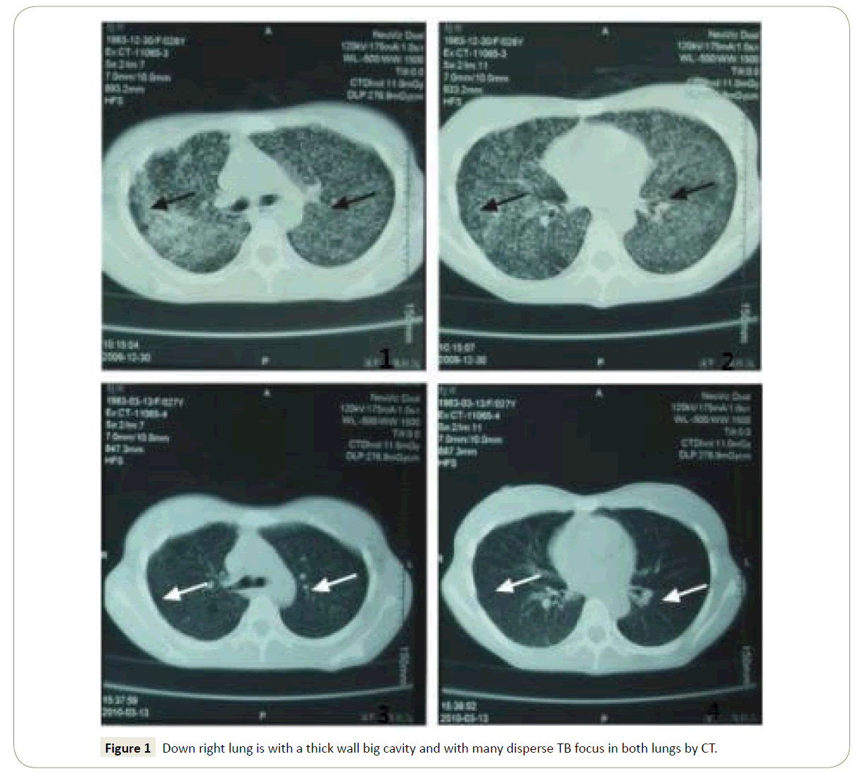 insights-chest-diseases-big-cavity