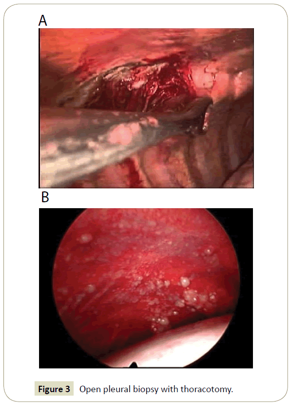 insights-chest-diseases-pleural-biopsy