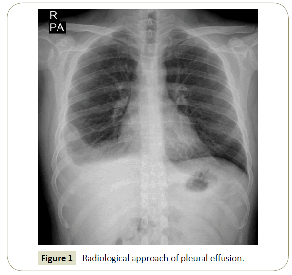 insights-chest-diseases-pleural-effusion