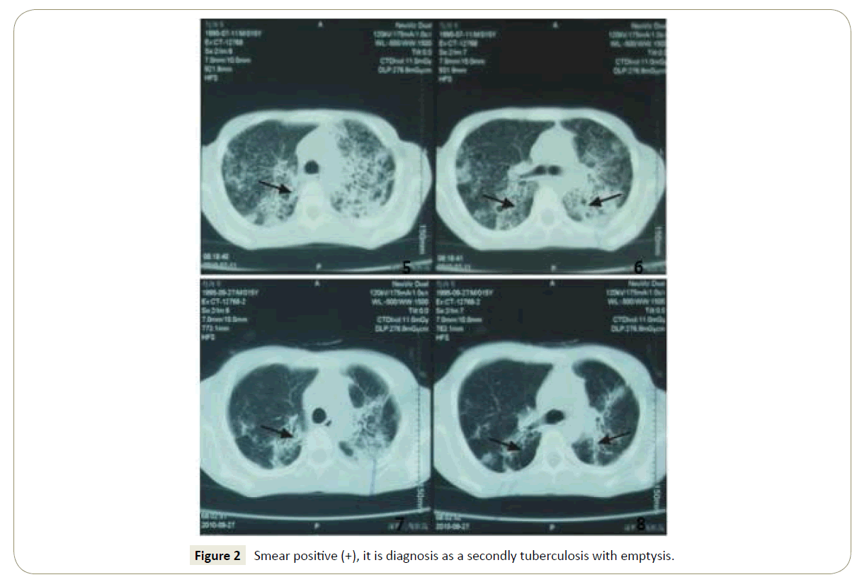 insights-chest-diseases-secondly-tuberculosis