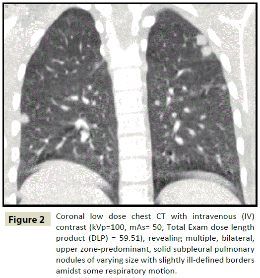 insightsinchestdiseases-Coronal-low-dose-chest