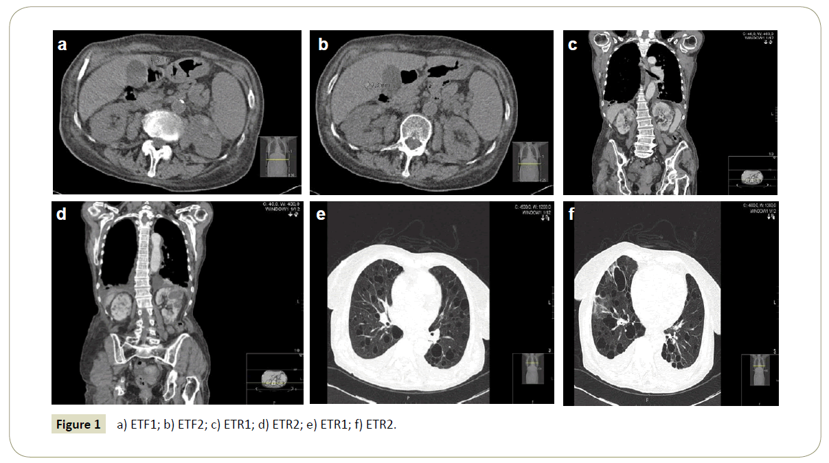 insightsinchestdiseases-ETF1-ETF2