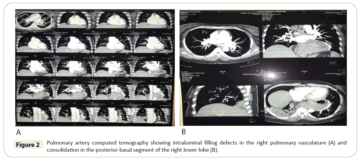 insightsinchestdiseases-Pulmonary-artery