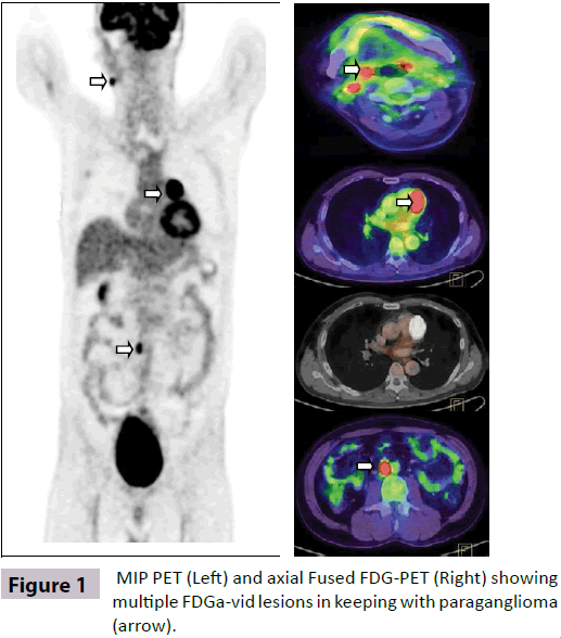 insightsinchestdiseases-axial-Fused-FDG-PET