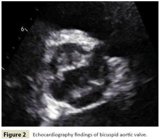 insightsinchestdiseases-bicuspid-aortic-valve