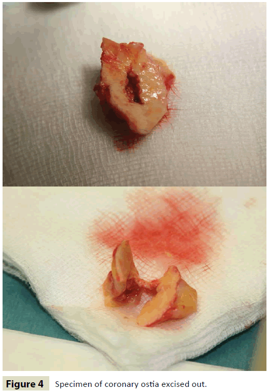 insightsinchestdiseases-coronary-ostia-excised