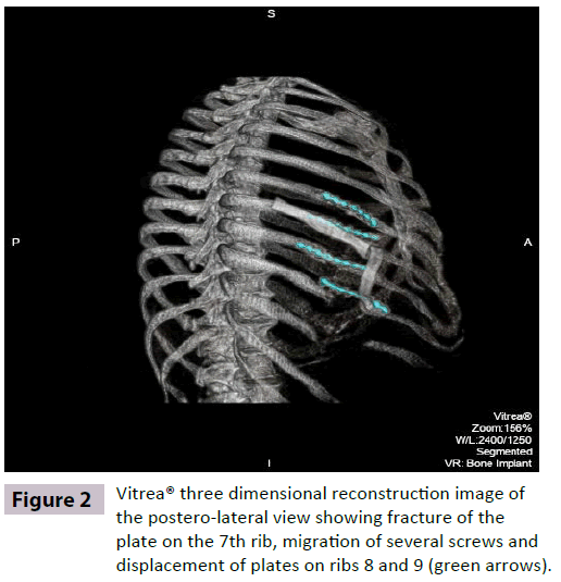 insightsinchestdiseases-postero-lateral-fracture