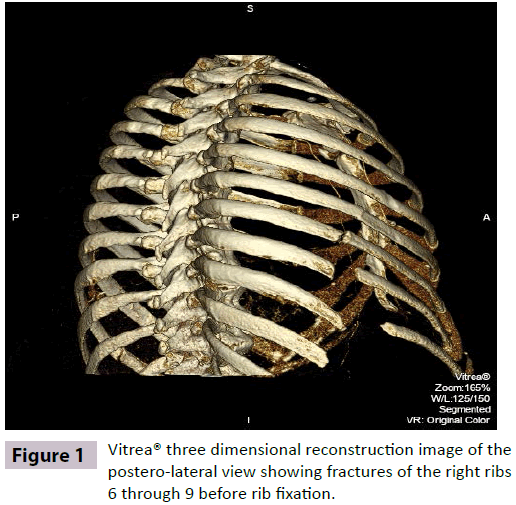 insightsinchestdiseases-reconstruction-image